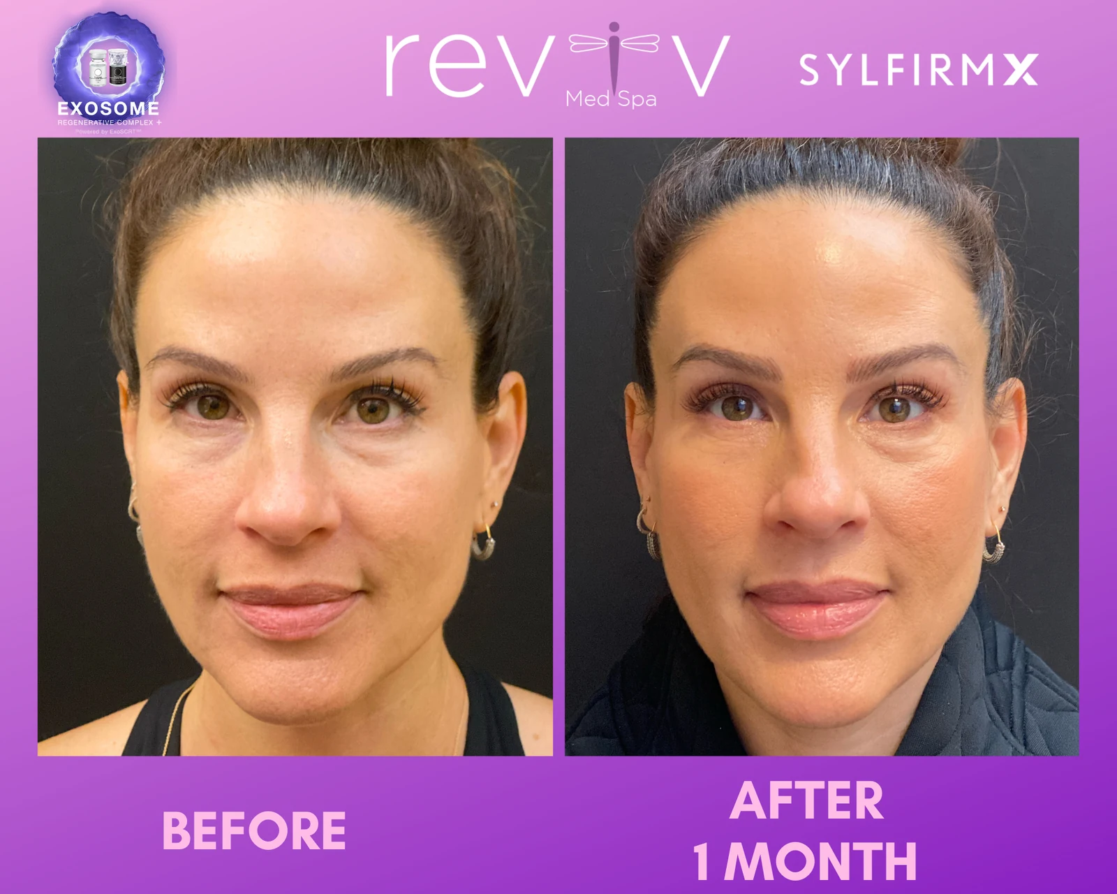 Reviv Med Spa patient before and after — Sylfirm X, Millbrae, California